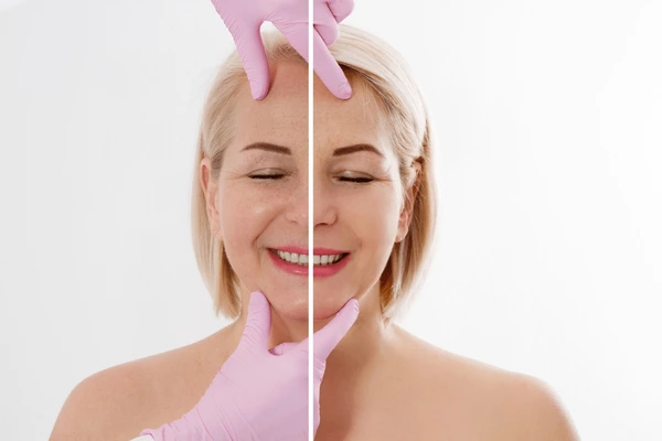 Carbon Laser Treatment in Lucknow